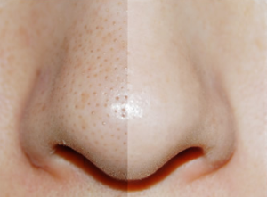 鼻の中心で汚れ比較